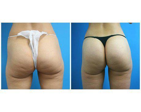 brazilian booty lift before and after