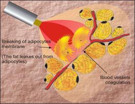 Laser Liposuction Explained