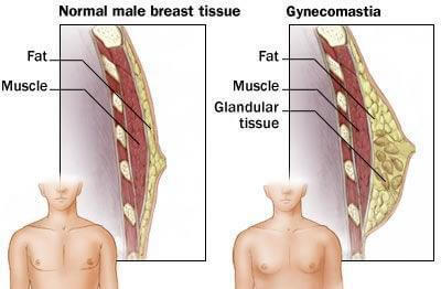 Gynecomastia Los Angeles
