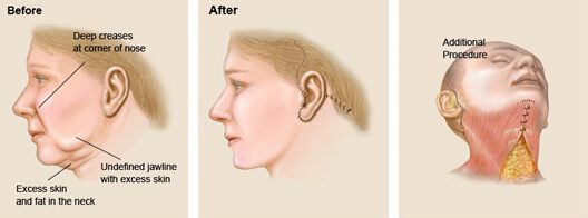 Before and After a Face Lift