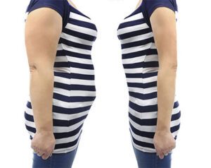 non invasive tummy tuck near me non invasive tummy tuck near me