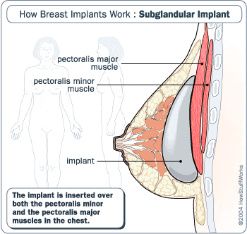 Over the muscle breast implant