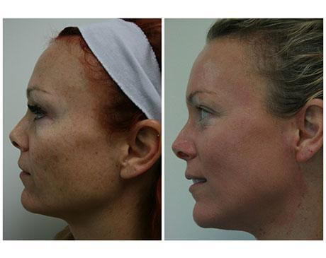 Case 5842 - PDT Gallery (Before & After)