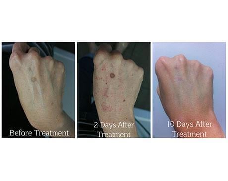 Case 992 - PDT Laser Gallery (Before & After)