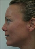 Real Patient Stories - Kristi - After(2) - Younique Cosmetic Surgery