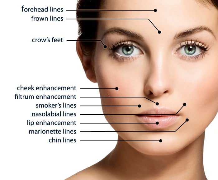 Dermal Fillers Treatment Areas