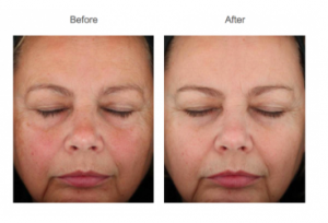 Los Angeles Chemical Face Peel Before and After