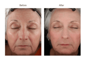 laser skin resurfacing before and after photos