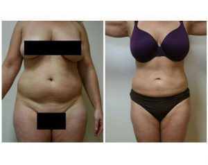 Before and After Liposuction