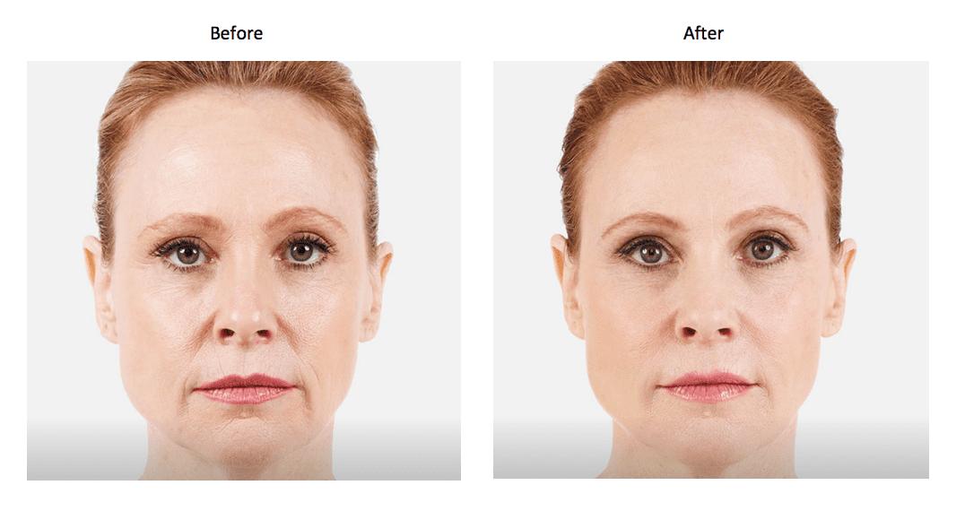 Voluma® Injections Los Angeles NonSurgical Filler for Cheeks