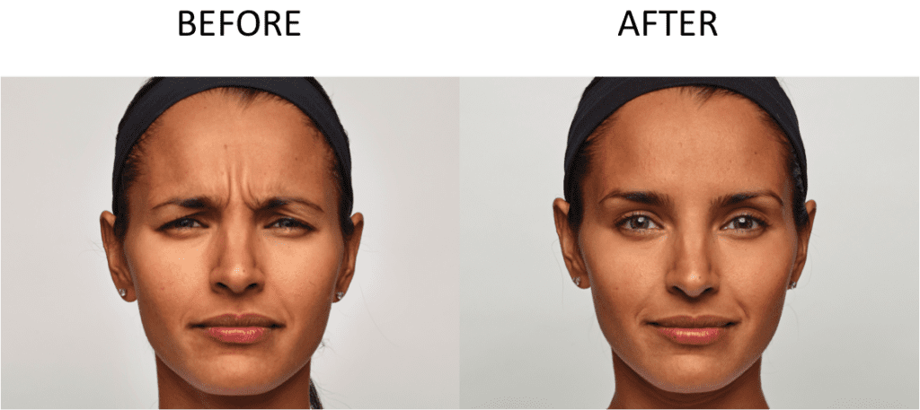 Before and After Dysport Treatment