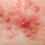 Acne Outbreak On Face