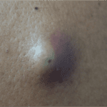 Close up of a cyst