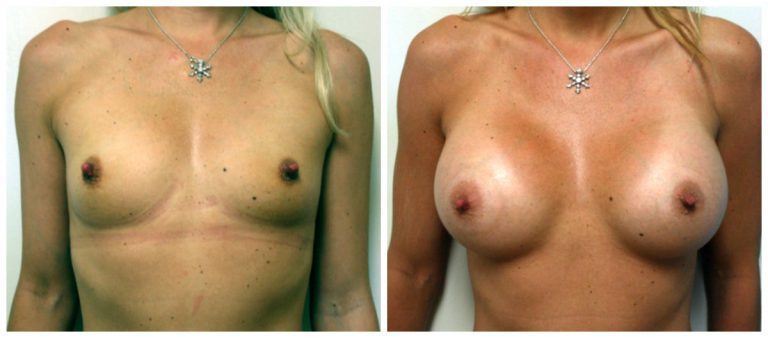 best breast augmentation los angeles before and after case 3429