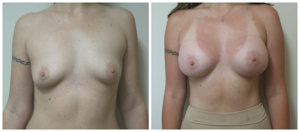 los angeles breast augmentation before and after case 3808