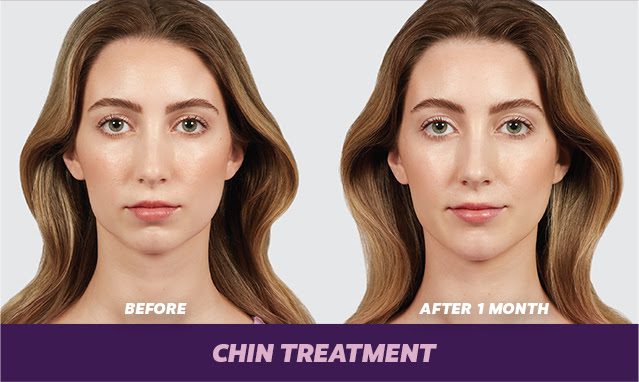 Chin Augmentation Los Angeles