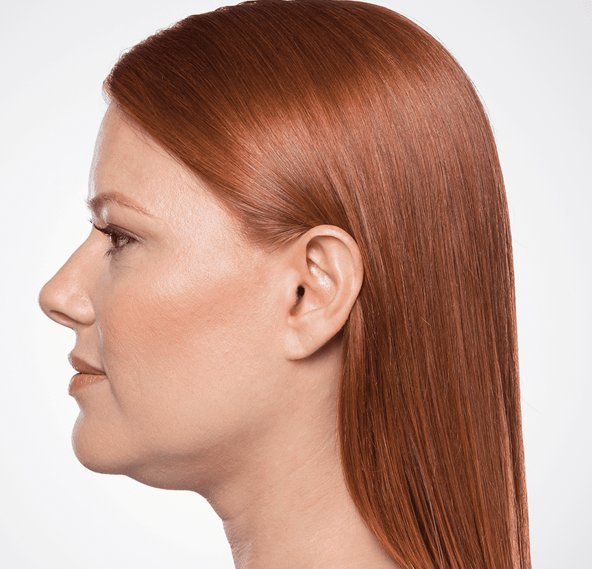 Get Rid of Double Chin Los Angeles