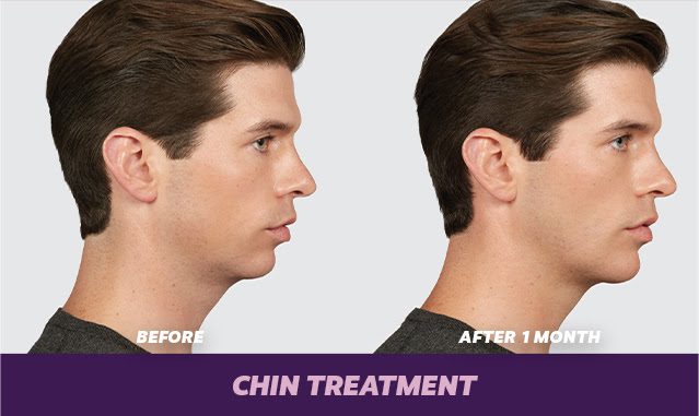 juvederm for chin for men