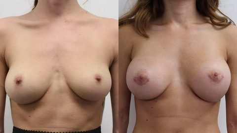 Case 11190 Younique Before & After Breast Augmentation