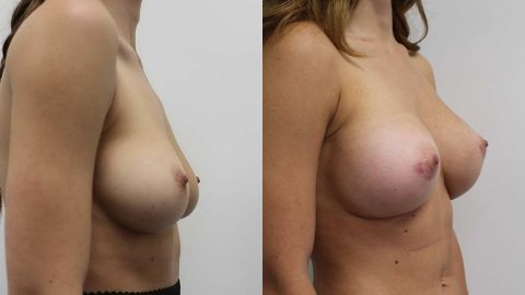 Before and After Breast Augmentation Side: Case 11190