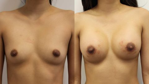 Before and After Breast Augmentation: Case 11252 Younique
