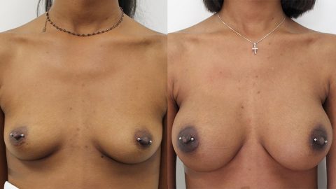 Younique Case 11924 Breast Augmentation Los Angeles