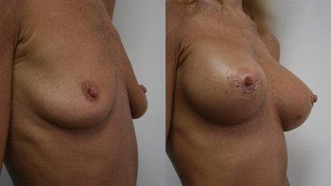 Case 1344 Younique Before & After Breast Augmentation Side
