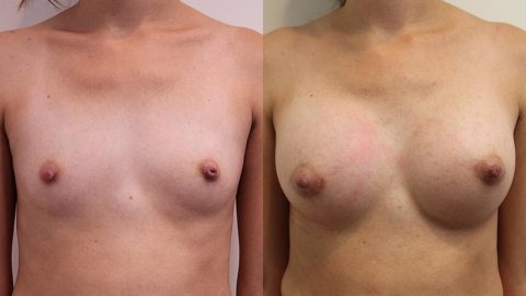 Breast Augmentation Los Angeles Before & After: Case 14327