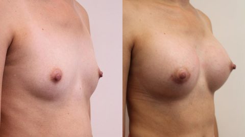 Before and After Breast Augmentation Side: Case 14327