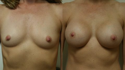 Before and After Breast Augmentation: Case 1888 Younique