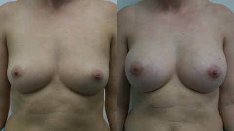 Before and After Breast Augmentation: Case 203 Younique