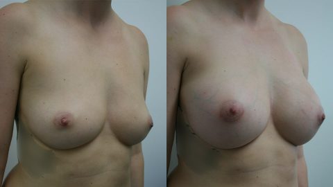 Before and After Breast Augmentation Side: Case 203 Younique