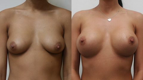Case 2414 Breast Augmentation Younique Before & After