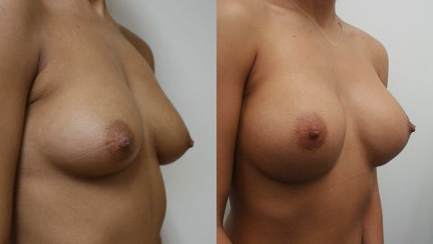 Case 2414 Breast Augmentation Younique Before & After Side