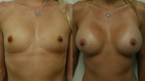 Case 3429 Younique Before & After Breast Augmentation in Los Angeles