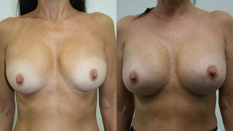 Before and After Younique Breast Augmentation: Case 7048