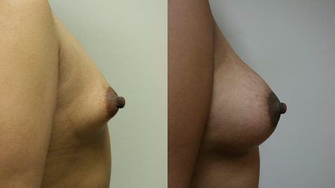 Case 9512 Younique Before & After Breast Augmentation Side