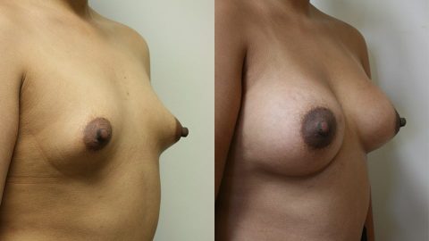 Case 9512 Younique Before & After Breast Augmentation Side 2