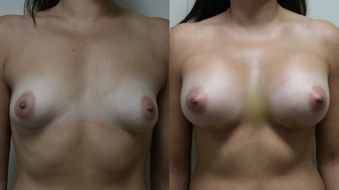 Case 9521 Younique Before & After Breast Augmentation