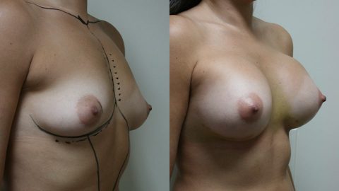 Case 9521 Younique Before & After Breast Augmentation Side