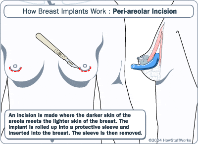 Scalpel cutting around nipple