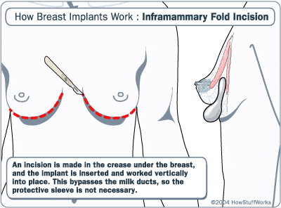 Scalpel cutting the breasts