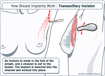 Scalpel cutting the armpit