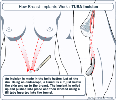 Scalpel cutting above belly button