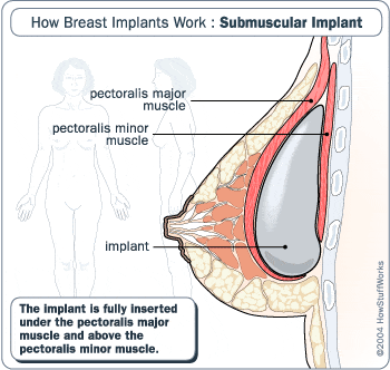 Implant placed under pectoral muscle