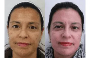 Before and after facial rejuvenation treatment at a plastic surgery center.