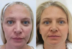 Before and after images of a woman's facial rejuvenation surgery.