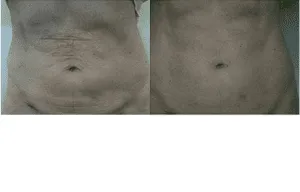 Before and after image of a tummy tuck procedure showing reduced abdominal wrinkles.