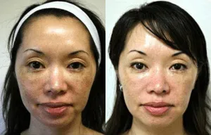 Before and after images of a woman showing results of plastic surgery or skincare treatment.
