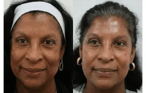 Before and after image of a woman showing facial rejuvenation results.